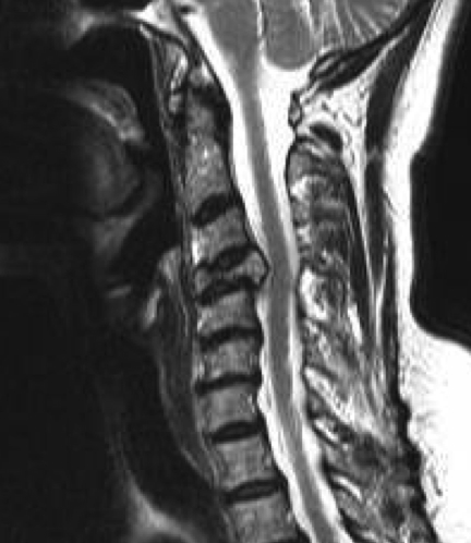 Cervical Metastasis MRI